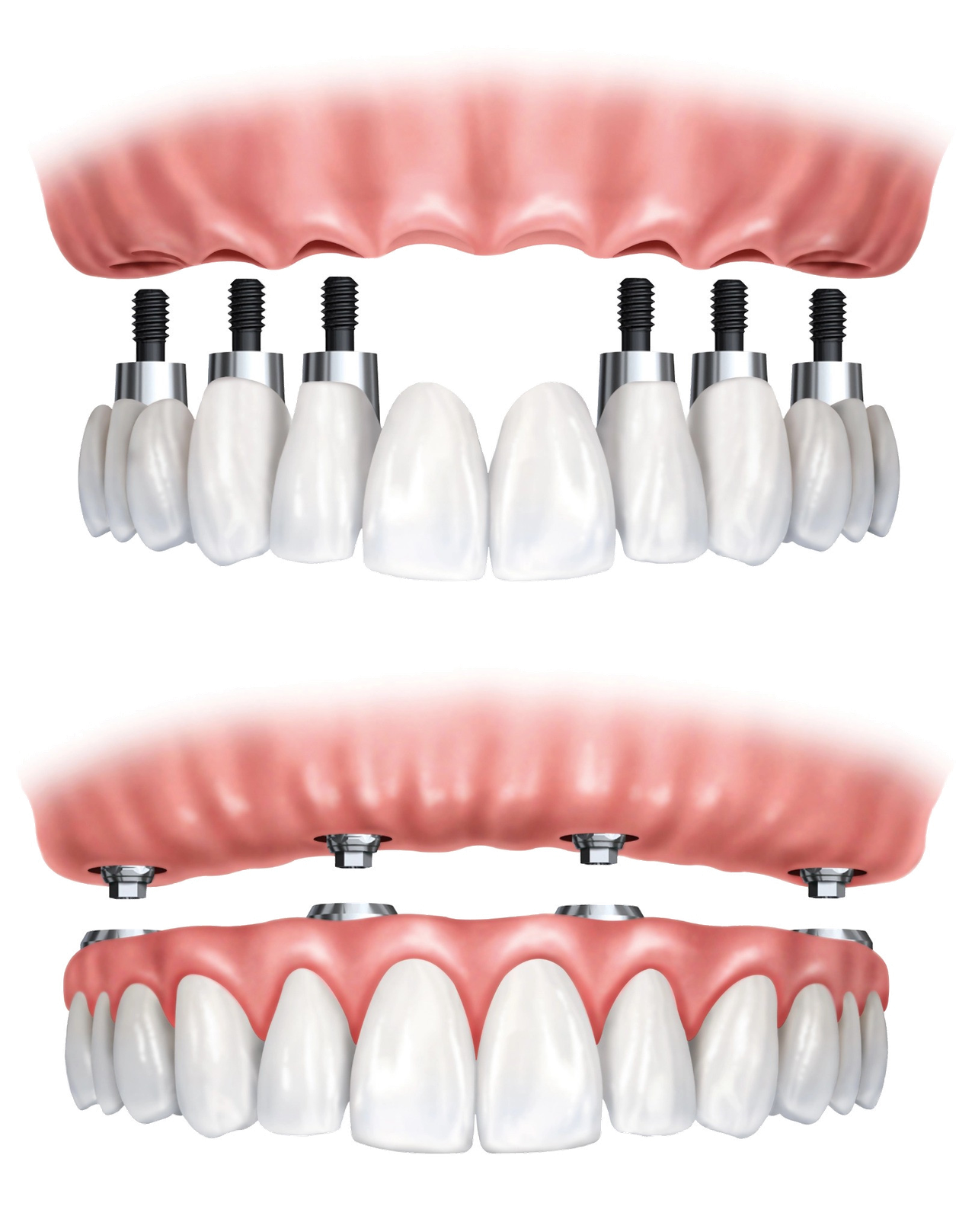 Educational illustration of full-arch implant-supported replacement designs.